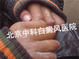 孩子白癜风怎么办