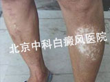 白癜风该注意什么